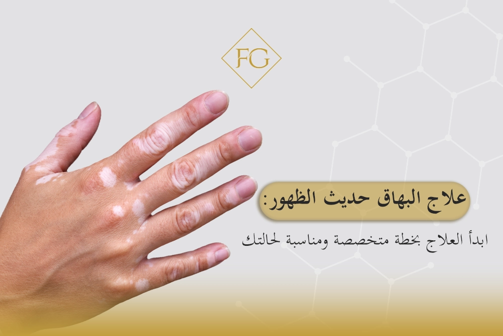 علاج البهاق حديث الظهور