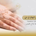 علاج البهاق في دبي