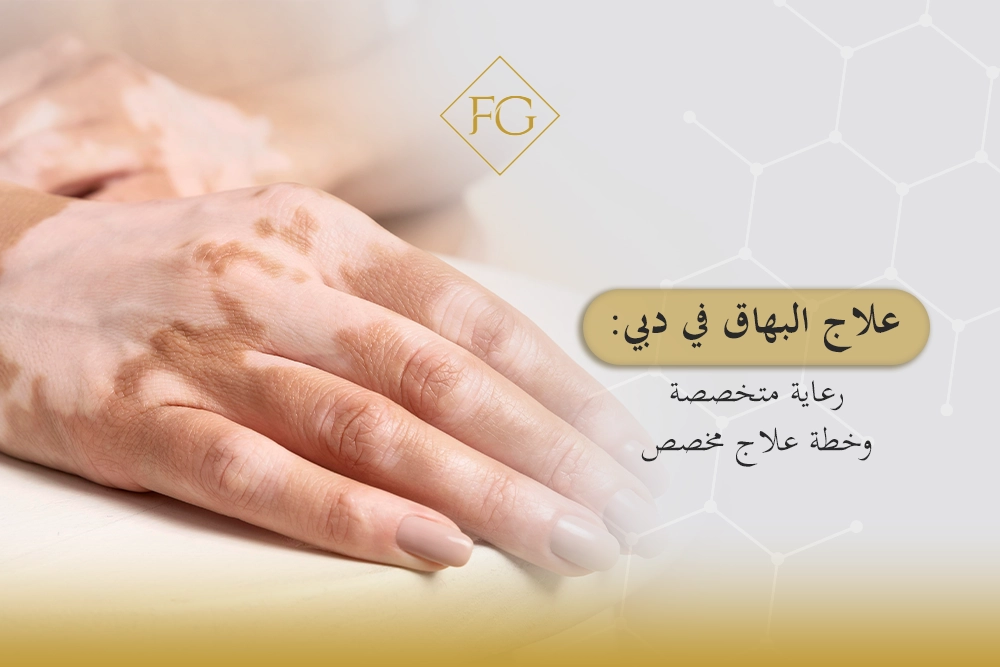 علاج البهاق في دبي