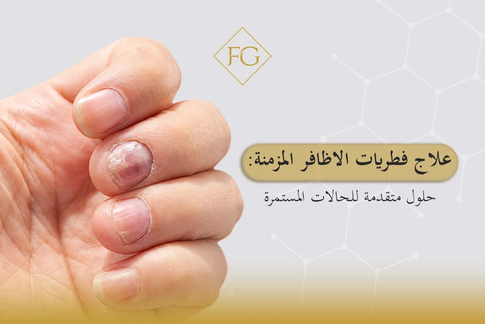 علاج فطريات الاظافر المزمنة