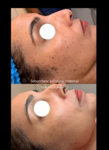 علاج ندبات حب الشباب - scar removal in dubai